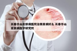 长春华山皮肤病医院治银屑病好么 长春华山皮肤病医学研究院