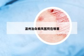 温州治白癜风医院在哪里