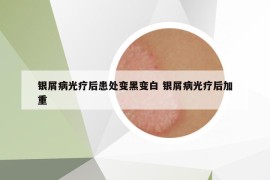 银屑病光疗后患处变黑变白 银屑病光疗后加重