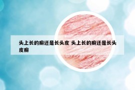 头上长的癣还是长头皮 头上长的癣还是长头皮癣