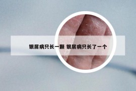 银屑病只长一颗 银屑病只长了一个