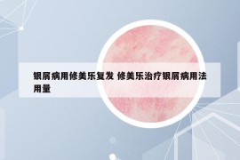 银屑病用修美乐复发 修美乐治疗银屑病用法用量