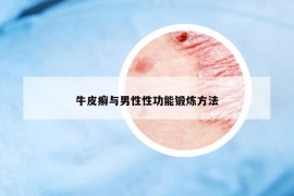 牛皮癣与男性性功能锻炼方法