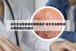 哈尔滨治银屑病去哪里最好 哈尔滨治银屑病去哪里最好的医院