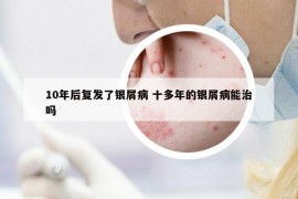 10年后复发了银屑病 十多年的银屑病能治吗