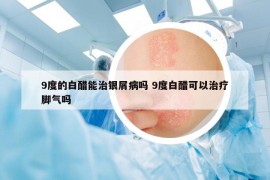 9度的白醋能治银屑病吗 9度白醋可以治疗脚气吗