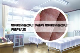 银屑病会通过乳汁传染吗 银屑病会通过乳汁传染吗女性