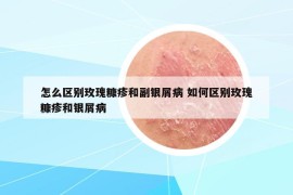 怎么区别玫瑰糠疹和副银屑病 如何区别玫瑰糠疹和银屑病