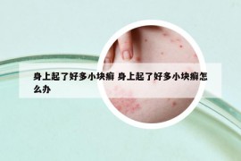 身上起了好多小块癣 身上起了好多小块癣怎么办