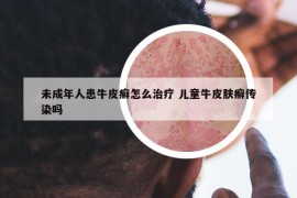 未成年人患牛皮癣怎么治疗 儿童牛皮肤癣传染吗