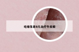 吃维生素B几治疗牛皮癣