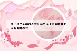 头上长了头癣的人怎么治疗 头上长癣有什么治疗的好办法