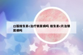 口服维生素c治疗银屑病吗 维生素c片治银屑病吗