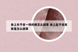 身上长干皮一样的癣怎么回事 身上起干皮皮屑是怎么回事