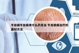 牛批癣牛批癣用什么药膏治 牛皮肤癣治疗的最好方法