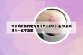 银屑病皮损的地方为什么不会长汗毛 银屑病皮损一直不消退