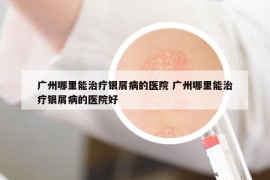 广州哪里能治疗银屑病的医院 广州哪里能治疗银屑病的医院好