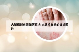 大腿根部有藓如何解决 大腿根有癣的症状图片