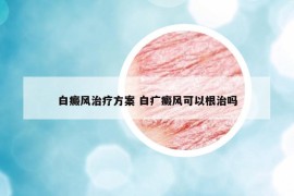 白癜风治疗方案 白疒癜风可以根治吗