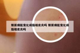 银屑病能变化成指端皮炎吗 银屑病能变化成指端皮炎吗