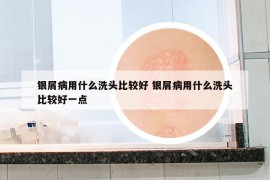 银屑病用什么洗头比较好 银屑病用什么洗头比较好一点