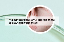 牛皮癣的病因推荐迎泽中心银屑超值 太原市迎泽中心医院皮肤科怎么样