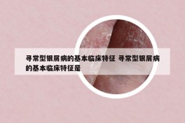 寻常型银屑病的基本临床特征 寻常型银屑病的基本临床特征是