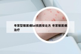 寻常型银屑病lai找西安北方 寻常银屑病治疗