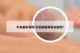 牛皮癣长寿吗 牛皮肤癣寿命会短吗?