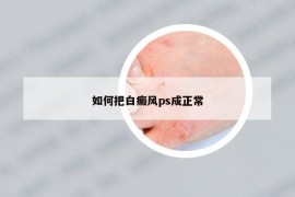 如何把白癜风ps成正常