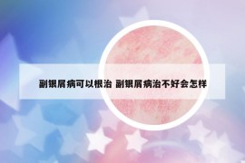 副银屑病可以根治 副银屑病治不好会怎样