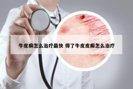 牛皮癣怎么治疗最快 得了牛皮皮癣怎么治疗