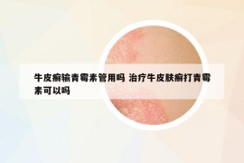 牛皮癣输青霉素管用吗 治疗牛皮肤癣打青霉素可以吗