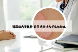 银屑病大学体检 银屑病能过大学生体检么