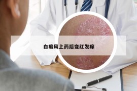 白癜风上药后变红发痒