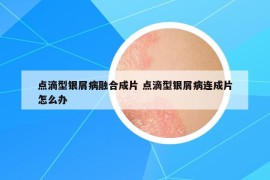 点滴型银屑病融合成片 点滴型银屑病连成片怎么办