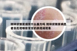 斑块状银屑病有什么偏方吗 斑块状银屑病患者会出现哪些常见的表现或现象