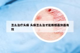 怎么治疗头癣 头癣怎么治才能断根最快最有效