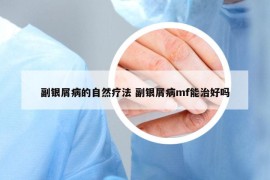 副银屑病的自然疗法 副银屑病mf能治好吗