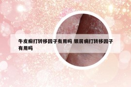 牛皮癣打转移因子有用吗 银屑病打转移因子有用吗