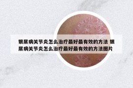 银屑病关节炎怎么治疗最好最有效的方法 银屑病关节炎怎么治疗最好最有效的方法图片