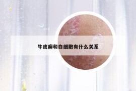 牛皮癣和白细胞有什么关系