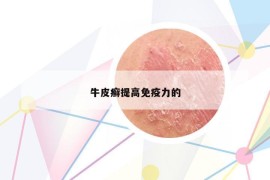 牛皮癣提高免疫力的