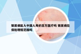 银屑病能入中国人寿的百万医疗吗 银屑病在保险理赔范围吗