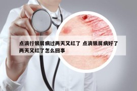 点滴行银屑病过两天又红了 点滴银屑病好了两天又红了怎么回事