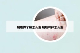 屁股得了癣怎么治 屁股有藓怎么治