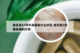 维生素b7对牛皮癣有什么好处 维生素b对银屑病的疗效