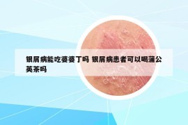 银屑病能吃婆婆丁吗 银屑病患者可以喝蒲公英茶吗