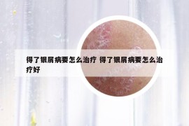 得了银屑病要怎么治疗 得了银屑病要怎么治疗好