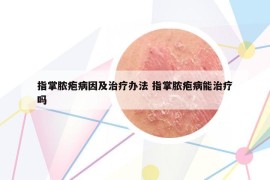 指掌脓疱病因及治疗办法 指掌脓疱病能治疗吗